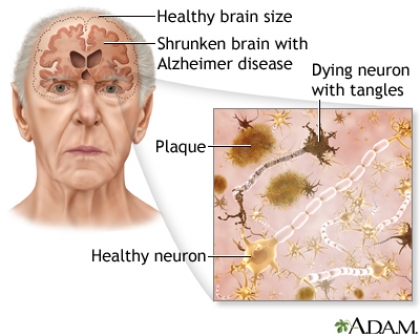 Alzheimer's disease